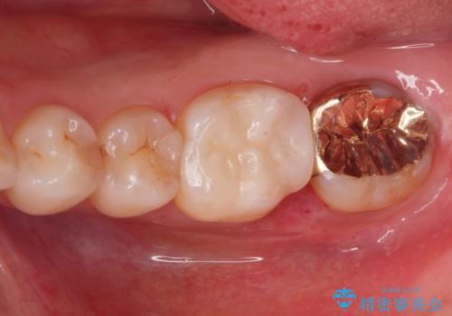 歯が黒くて虫歯じゃないかと心配して来院の治療後