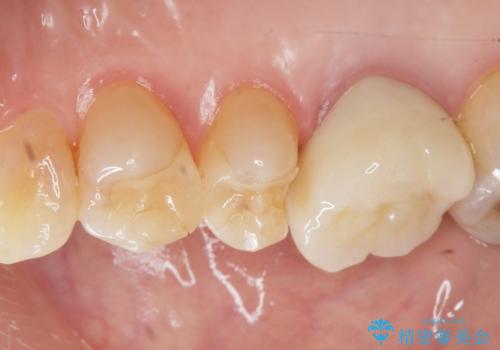 セラミックインレーのやりかえの治療前