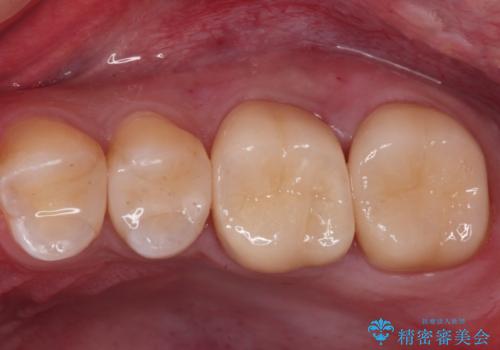 ジルコニアクラウン治療の治療後