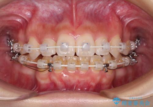 デコボコと八重歯の目立つ前歯 ワイヤー装置による抜歯矯正の治療中