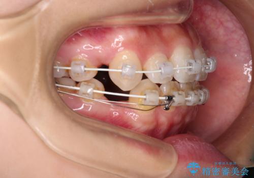 デコボコと八重歯の目立つ前歯 ワイヤー装置による抜歯矯正の治療中