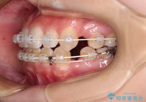 デコボコと八重歯の目立つ前歯 ワイヤー装置による抜歯矯正の治療中