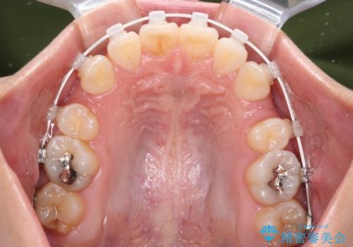 デコボコと八重歯の目立つ前歯　ワイヤー装置による抜歯矯正の治療中