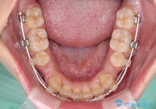 デコボコと八重歯の目立つ前歯 ワイヤー装置による抜歯矯正の治療中