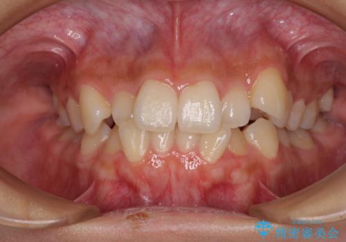 デコボコと八重歯の目立つ前歯　ワイヤー装置による抜歯矯正の治療前