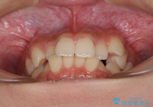 デコボコと八重歯の目立つ前歯 ワイヤー装置による抜歯矯正の治療前
