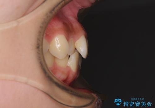 デコボコと八重歯の目立つ前歯 ワイヤー装置による抜歯矯正の治療前