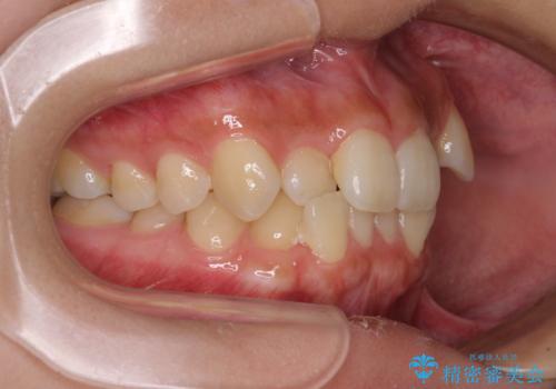 デコボコと八重歯の目立つ前歯　ワイヤー装置による抜歯矯正の治療前