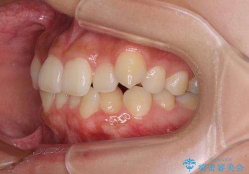 デコボコと八重歯の目立つ前歯 ワイヤー装置による抜歯矯正の治療前