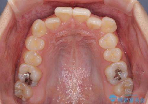 デコボコと八重歯の目立つ前歯 ワイヤー装置による抜歯矯正の治療前