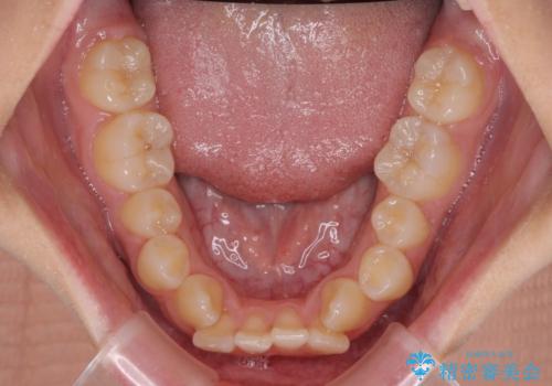 デコボコと八重歯の目立つ前歯 ワイヤー装置による抜歯矯正の治療前