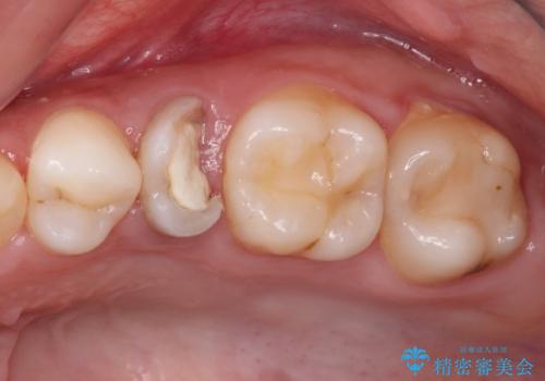 抜歯と言われた歯を残したい　部分矯正と外科処置を用いた補綴治療の症例 治療前