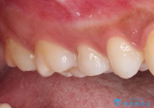 抜歯と言われた歯を残したい 部分矯正と外科処置を用いた補綴治療の治療前