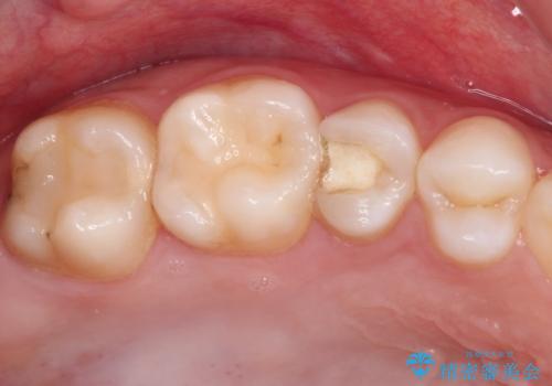 抜歯と言われた歯を残したい 部分矯正と外科処置を用いた補綴治療の治療前