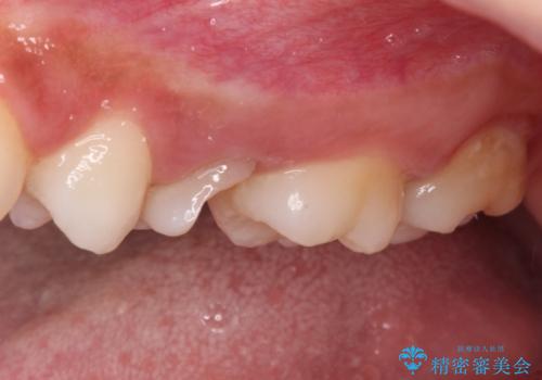 抜歯と言われた歯を残したい　部分矯正と外科処置を用いた補綴治療の治療前