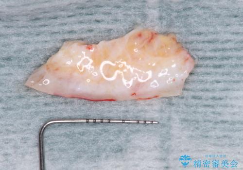 長く見える歯を治したい 歯肉移植による歯肉増大術の治療前