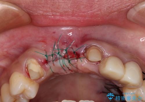 長く見える歯を治したい　歯肉移植による歯肉増大術の治療中