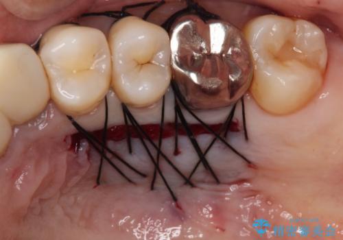 長く見える歯を治したい　歯肉移植による歯肉増大術の治療中