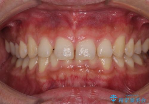 深い咬み合わせと隙間の空いた歯列をワイヤー矯正で改善の症例 治療前