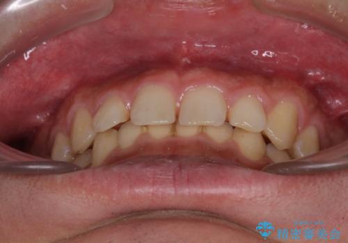 深い咬み合わせと隙間の空いた歯列をワイヤー矯正で改善の治療前