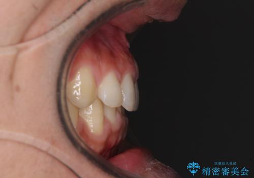 深い咬み合わせと隙間の空いた歯列をワイヤー矯正で改善の治療前