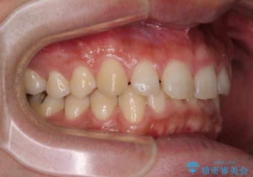 深い咬み合わせと隙間の空いた歯列をワイヤー矯正で改善の治療前