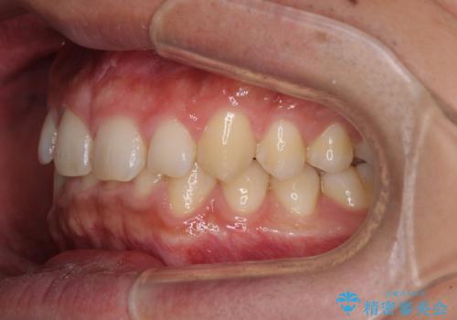 深い咬み合わせと隙間の空いた歯列をワイヤー矯正で改善の治療前