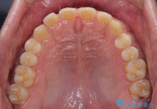 深い咬み合わせと隙間の空いた歯列をワイヤー矯正で改善の治療前