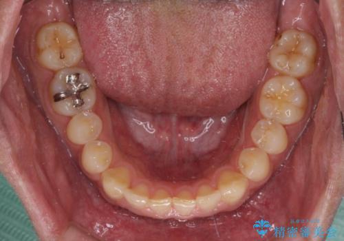 深い咬み合わせと隙間の空いた歯列をワイヤー矯正で改善の治療前