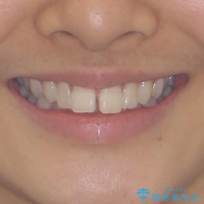 深い咬み合わせで前方に煽られた前歯 高校生のインビザライン矯正治療の治療前(顔貌)