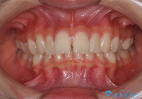 深い咬み合わせで前方に煽られた前歯 高校生のインビザライン矯正治療の症例 治療前