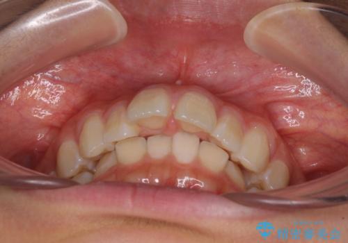 深い咬み合わせで前方に煽られた前歯 高校生のインビザライン矯正治療の治療前