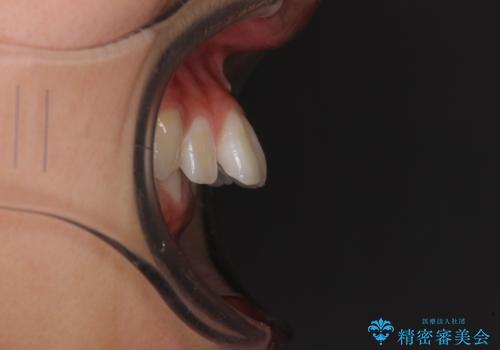 深い咬み合わせで前方に煽られた前歯 高校生のインビザライン矯正治療の治療前