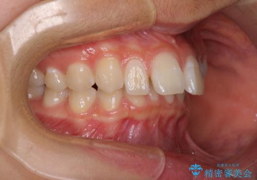 深い咬み合わせで前方に煽られた前歯 高校生のインビザライン矯正治療の治療前
