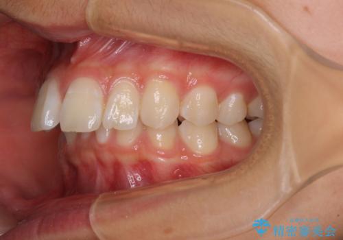 深い咬み合わせで前方に煽られた前歯 高校生のインビザライン矯正治療の治療前