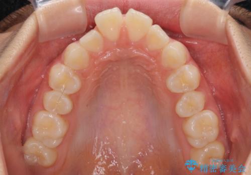 深い咬み合わせで前方に煽られた前歯 高校生のインビザライン矯正治療の治療前