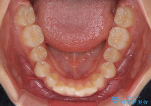 深い咬み合わせで前方に煽られた前歯 高校生のインビザライン矯正治療の治療前