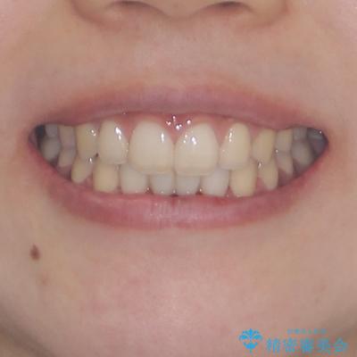 乳歯残存と欠損の前歯　矯正治療とオールセラミックブリッジ治療の治療後（顔貌）