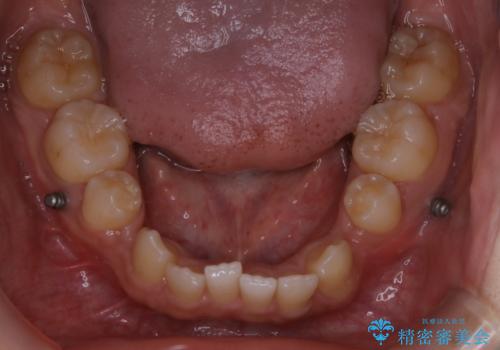 インビザライン単独でここまでできる!!抜歯矯正の治療中