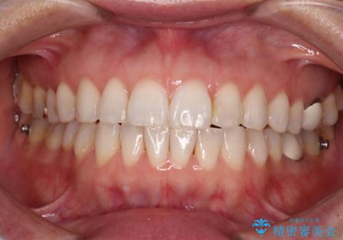 ちょっとしたデコボコをしっかりと改善したい インビザライン矯正の治療中