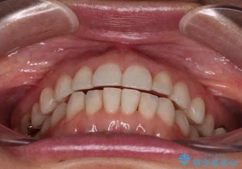 ちょっとしたデコボコをしっかりと改善したい インビザライン矯正の治療中