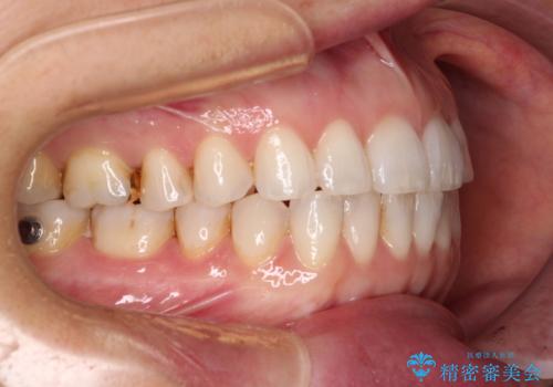 ちょっとしたデコボコをしっかりと改善したい インビザライン矯正の治療中