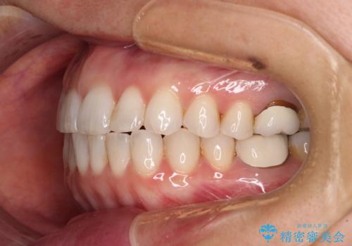 ちょっとしたデコボコをしっかりと改善したい インビザライン矯正の治療中