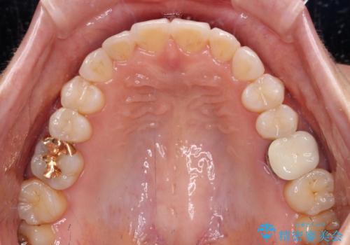 ちょっとしたデコボコをしっかりと改善したい インビザライン矯正の治療中