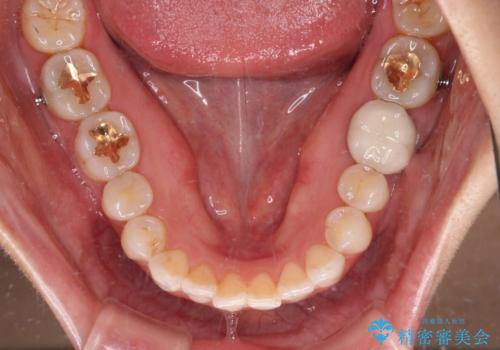 ちょっとしたデコボコをしっかりと改善したい インビザライン矯正の治療中