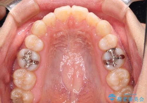 抜歯矯正の後戻り インビザライン・ライトによる矯正治療の治療中