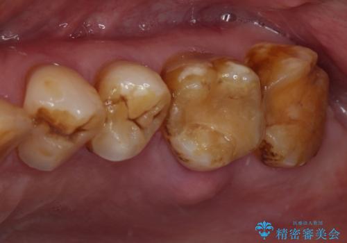 食事で割れてしまった奥歯 外科処置を用いた補綴治療の症例 治療前