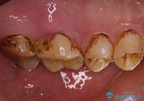 食事で割れてしまった奥歯 外科処置を用いた補綴治療の治療前