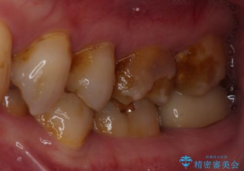 食事で割れてしまった奥歯 外科処置を用いた補綴治療の治療前