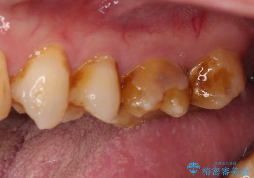 食事で割れてしまった奥歯 外科処置を用いた補綴治療の治療前